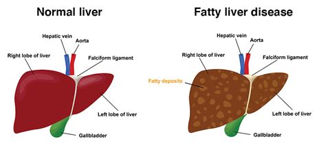 Best Liver disease due to fat accumulation Doctors in Roseville, .